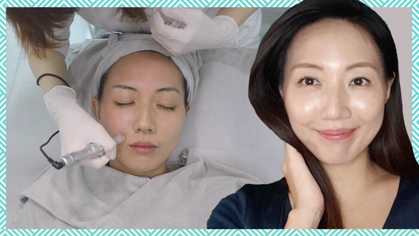 I Tried the NCTF Filorga Microneedling Treatment in Singapore